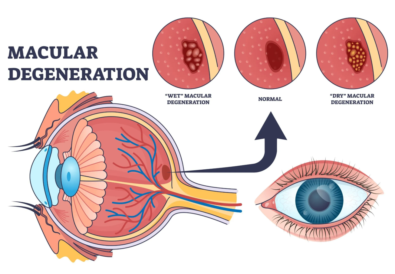 Age related Macular Degeneration