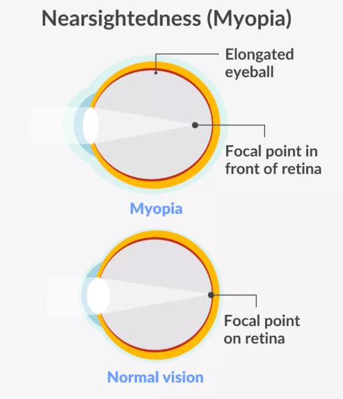 LASIK at Vala Eye Centre